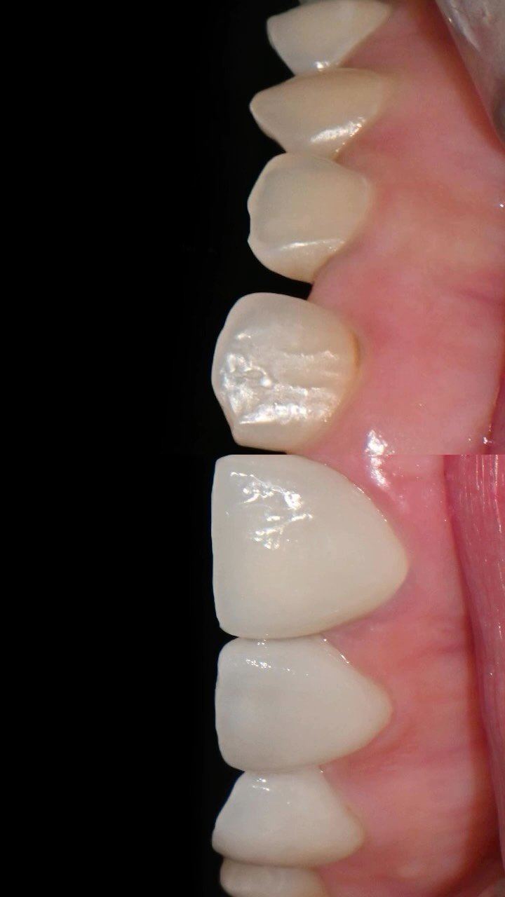 standard__dental 게시물 이미지: 💬치아 모양이 일률적이지 않고 벌어짐이 신경 쓰여요
웃을 때, 말할 때마다 신경...