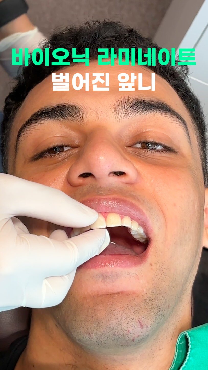 standard__dental 게시물 이미지: 자연치아의 복원과 복구,바이오닉 라미네이트 세팅 과정 보기!
✔️자연치아의...