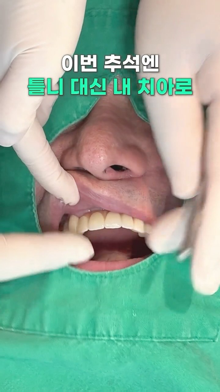 standard__dental 게시물 이미지: 이번 추석엔 틀니말고 내 치아로
#임플란트 #치과 #추석