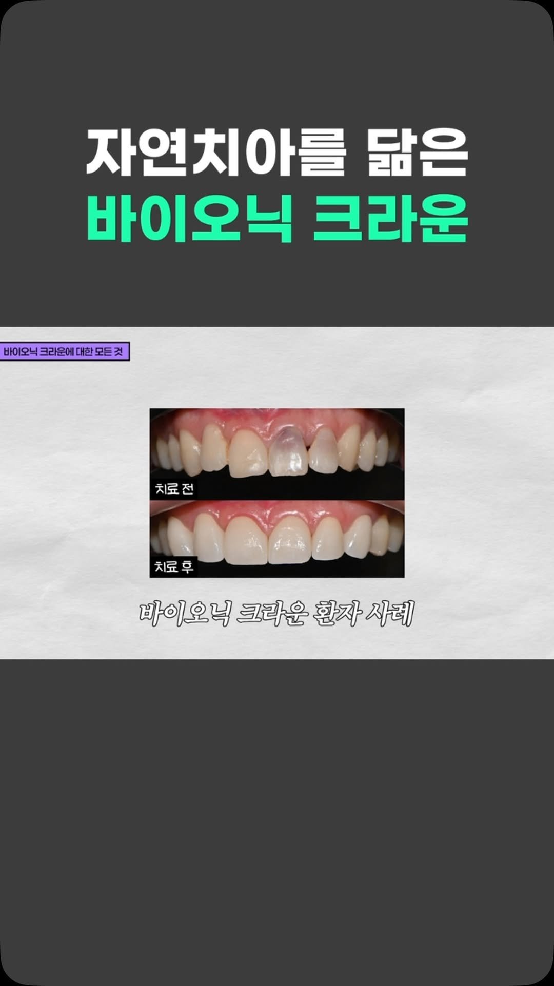 standard__dental 게시물 이미지: 라미네이트와 크라운의 중간 형태인 바이오닉크라운🦷
자연치아의 구조와 성질을 최대한...