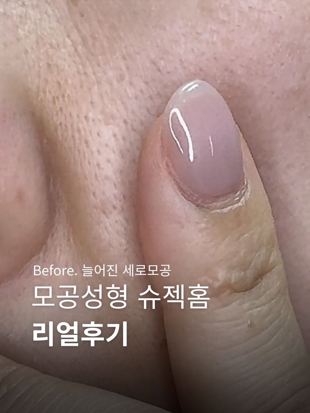 studio.m_u_s_e 게시물 이미지: 30대 들어서고 나니
예전엔 안 보이던 세로모공
축 처지는 탄력
거칠어지는...
