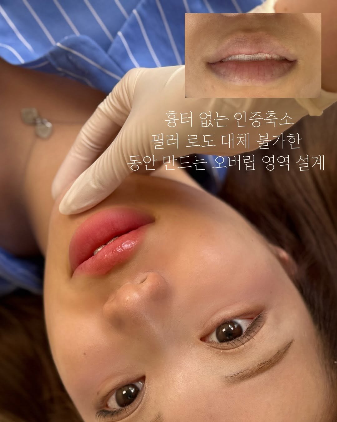 studiosoop_seoul 게시물 이미지: 아직두 중안부 , 인중 짧아보이기 위해

💄화장으로 대체 하시거나 ? 
흉터 까지...