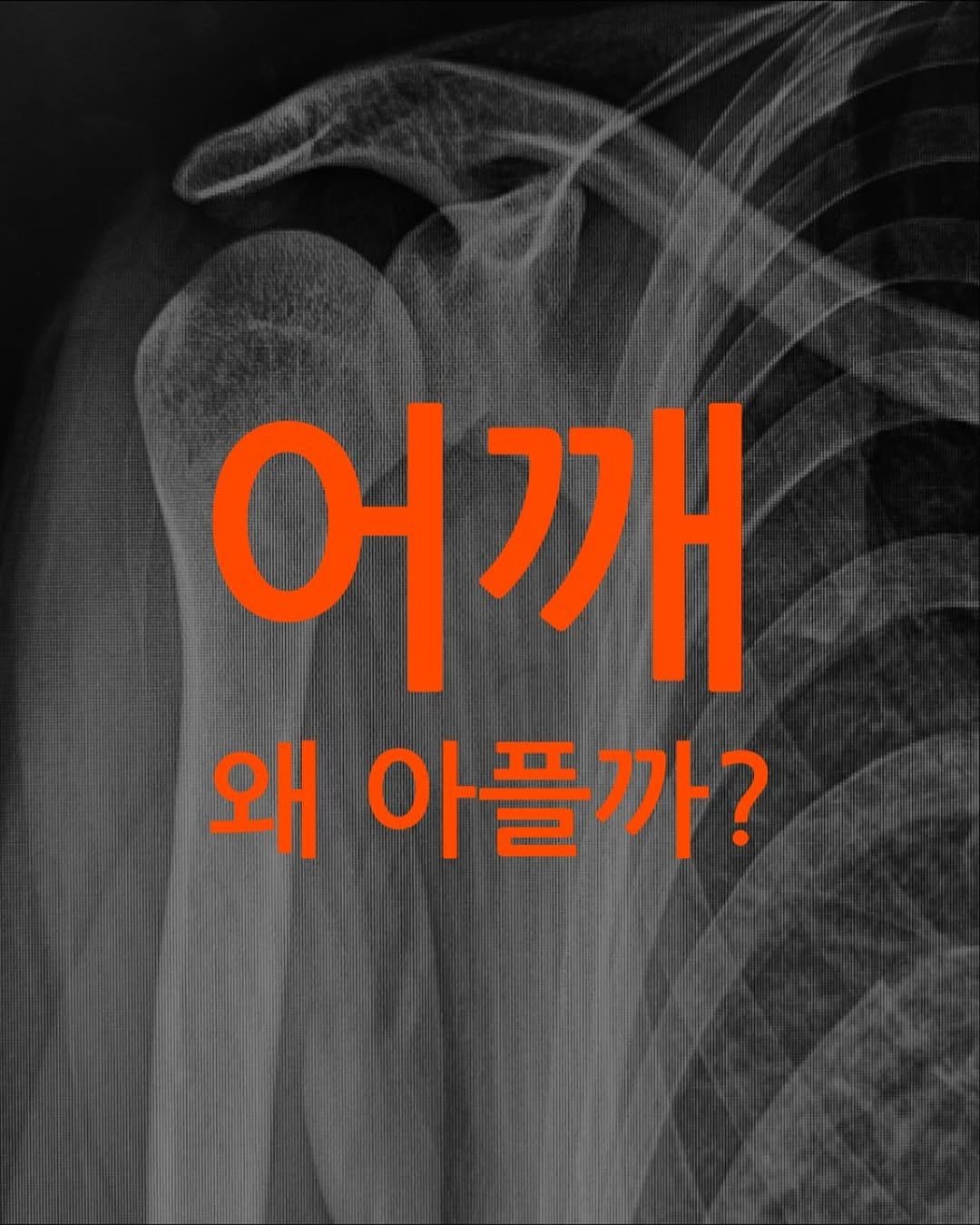 Photo shared by 섭쿠_어려운걸 쉽게 알려주는 사람 on November 13, 2025 tagging @icur_power. May be an image of xray, bone, poster and text that says '어깨 어 깨 왜 아플까?'.
