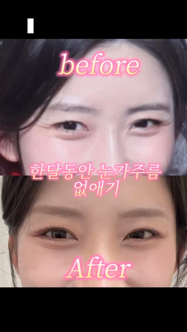 suface_hj 게시물 이미지: 🤦‍♀️ : 눈가 주름 정말 없앨 수 있는 거 맞나요?

저도 궁금해서...