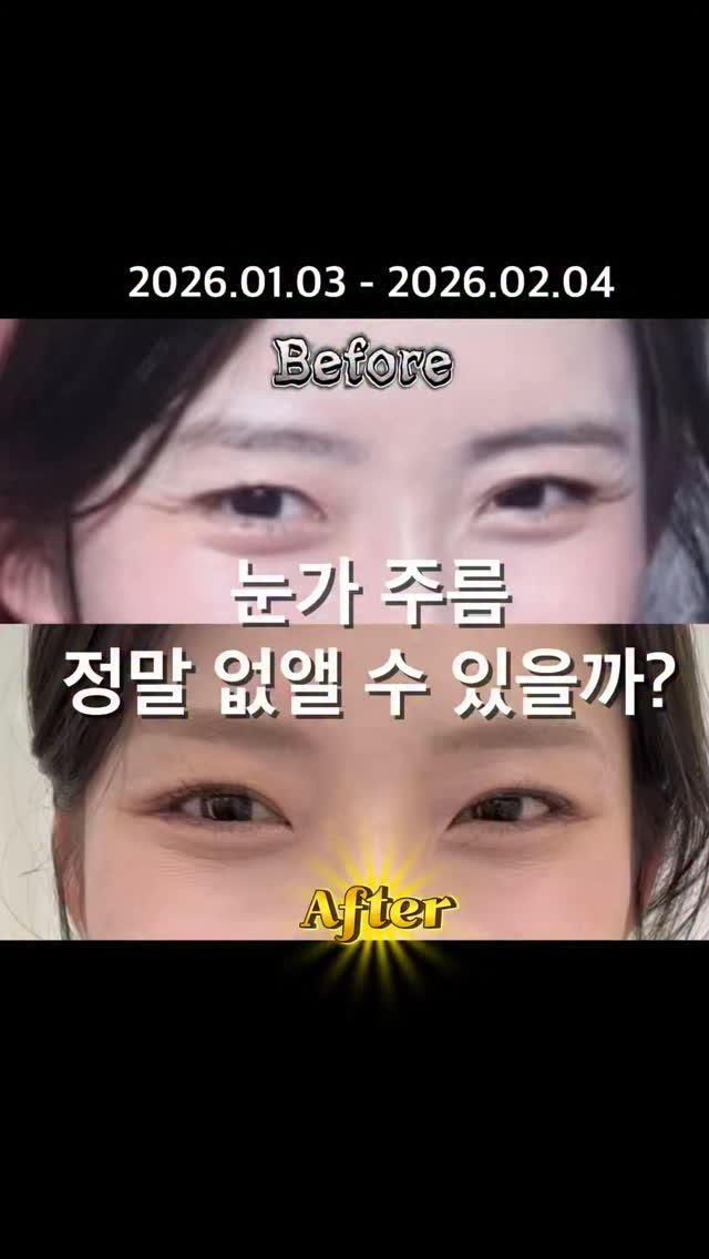 suface_hj 게시물 이미지: 1️⃣월부터 1️⃣달동안 진행한 
눈가 주름 없애기 챌린지‼️
#2탄✌️ 

눈가...