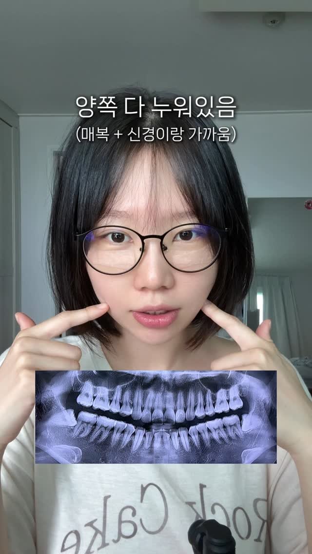 sunn416 게시물 이미지: 첫 사랑니.. 뽑았습니다.. 후관리 꿀팁 좀..
사랑니 맛집 정보는 디엠주시면 다...