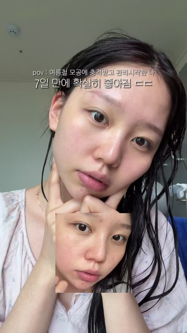 sunn416 게시물 이미지: 관리의 중요성 ㄷㄷ

여름이라 모공 늘어지고 트러블 범벅에,,
난리도...