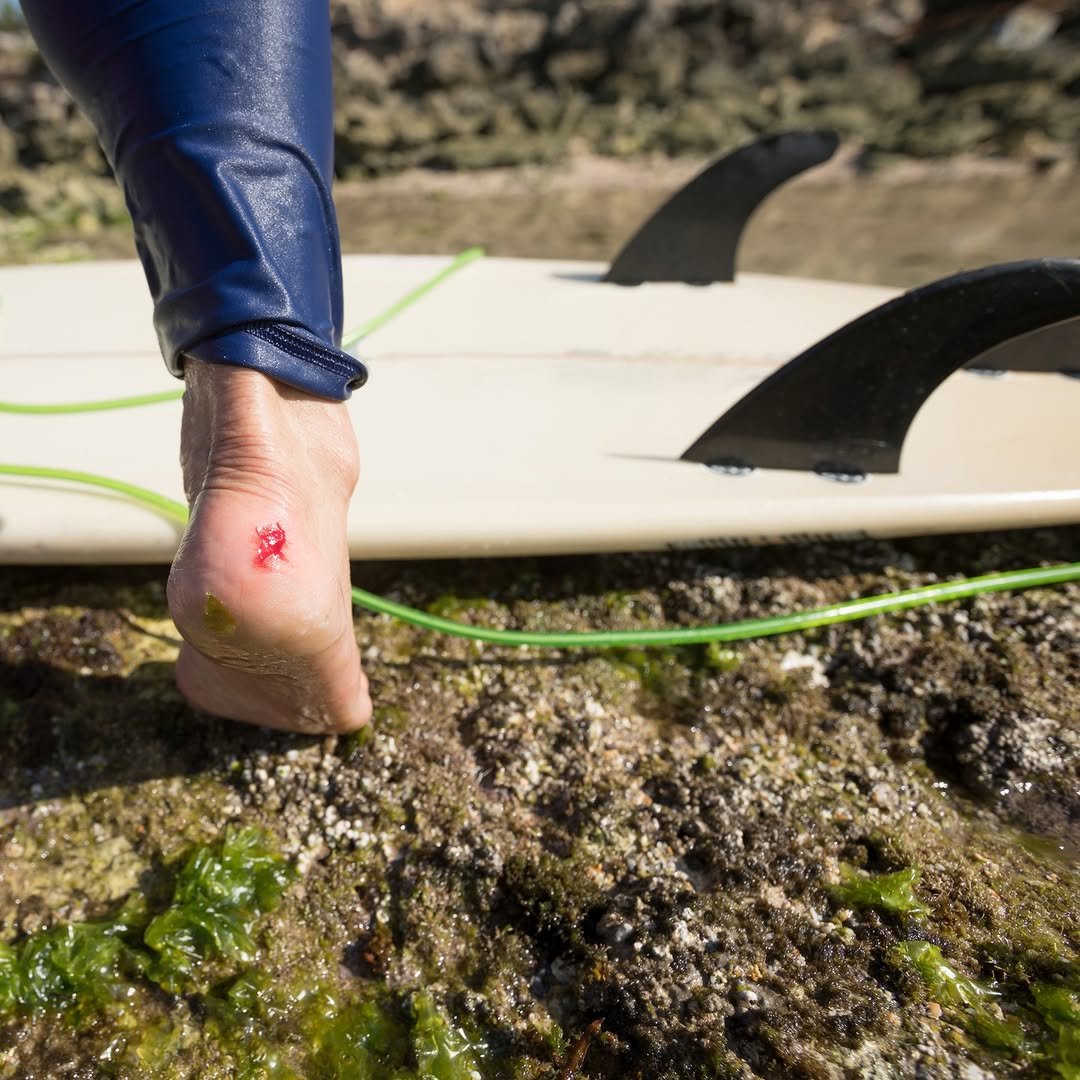 Is it safe to surf with an open wound?