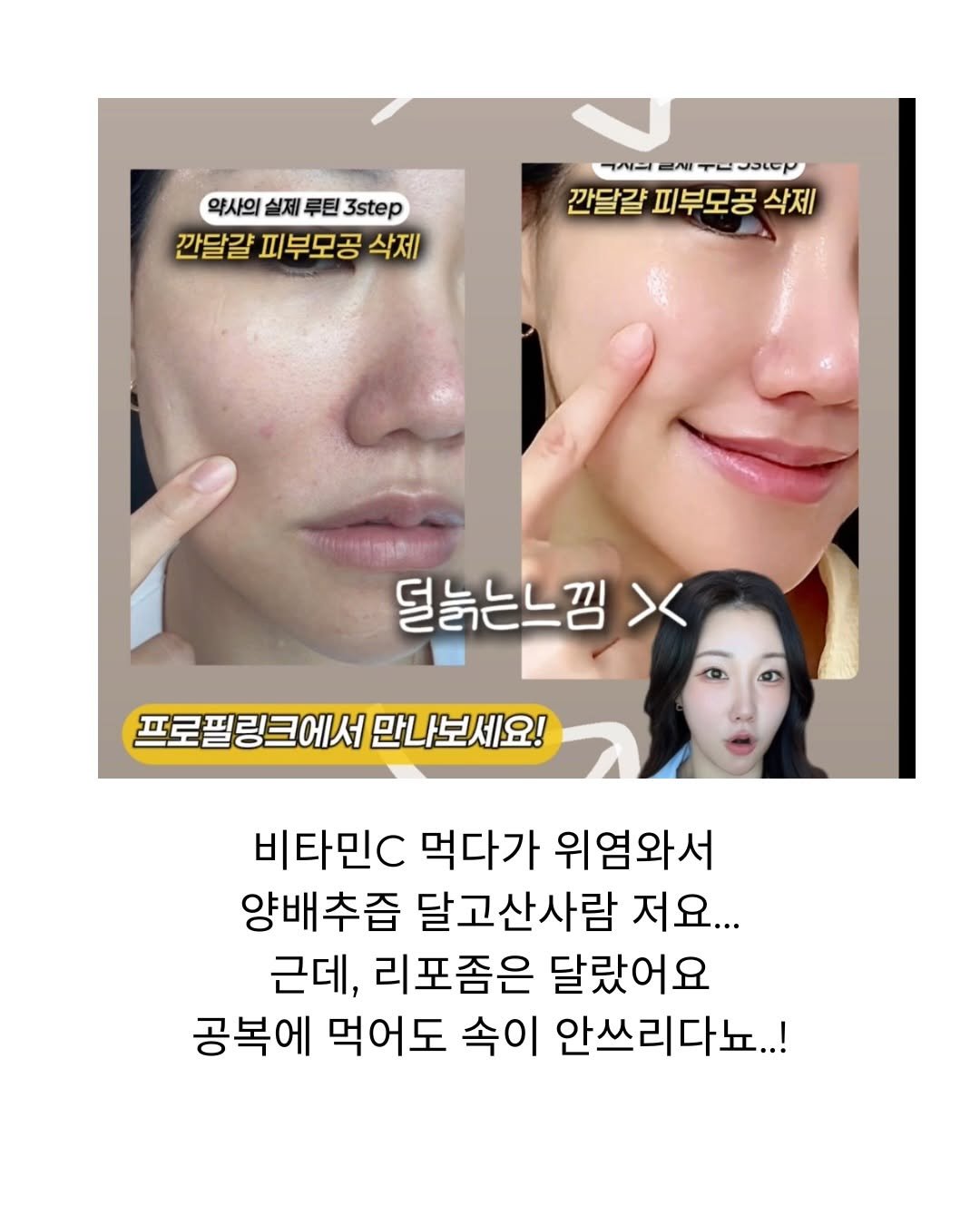 Photo by 아나 약사  | 김진아 on November 30, 2025. May be an image of text that says '약사의 실제 루틴 3step 깐달걀 피부모공 삭제 ㅋ지보ENT드C ベニI 2시 구물만0 ㅜ 깐달걀 피부모공 삭제 덜눈는느낌 X 프로필링크에서 프로필링크에서만나보세요! 만나보세요! 비타민C 먹다가 위염와서 양배추즙 달고산사람 저요... 근데, 리포좀은 달랐어요 공복에 먹어도 속이 안쓰리다뇨..!'.