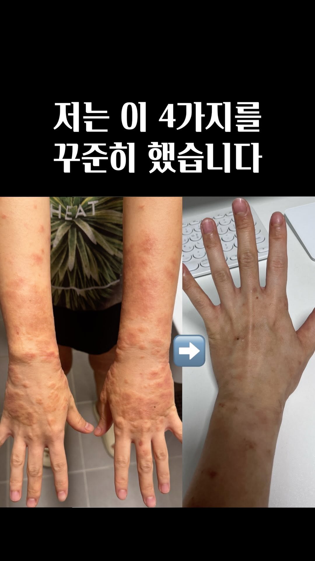 the_cle_ 게시물 이미지: 임신 소양증, 디엠으로 많이들 여쭤보셔서 저만의 극복 방밥 한번 싹 정리해봤습니다!...