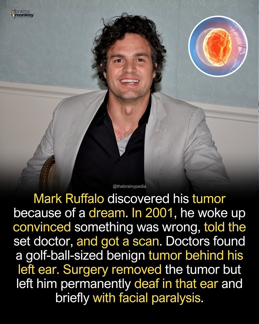 Photo by Brainypedia on January 14, 2026. May be an image of one or more people, magazine and text that says 'onkéy brainy monkey иAneuиe @t thebr thebrai ypedia Mark Ruffalo discovered his tumor because of a dream. In 2001, he woke up convinced something was wrong, told the set doctor, and got a scan. Doctors found a golf-ball-sized golf-ba benign tumor behind his left ear. Surgery removed the tumor but left him permanently deaf in that ear and briefly with facial paralysis.'.