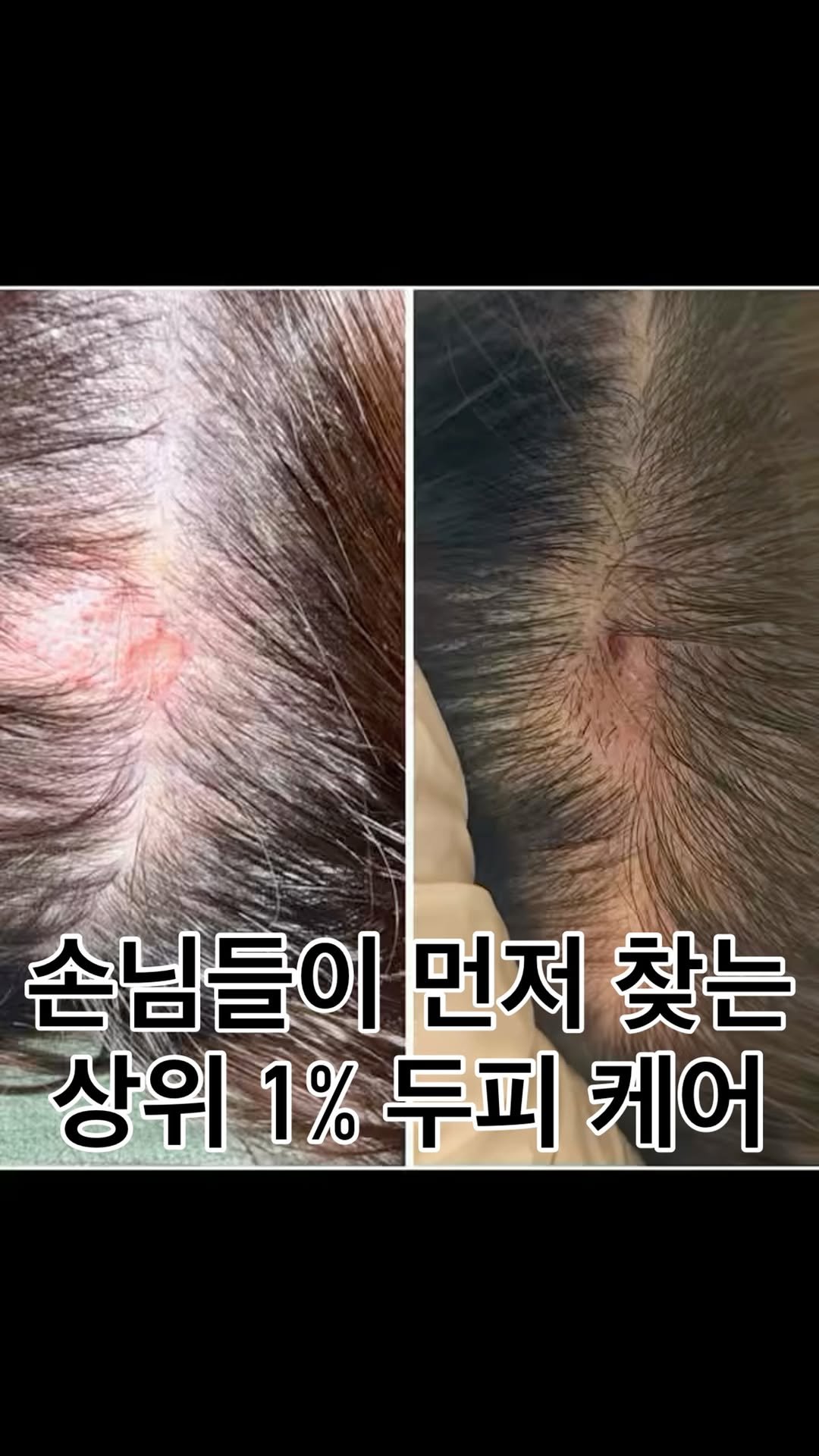 tinalab_c 게시물 이미지: 머리에 자꾸 손 가고, 기름지고, 머리카락 숭숭 빠지시죠? 뚝- 멈추세요!...