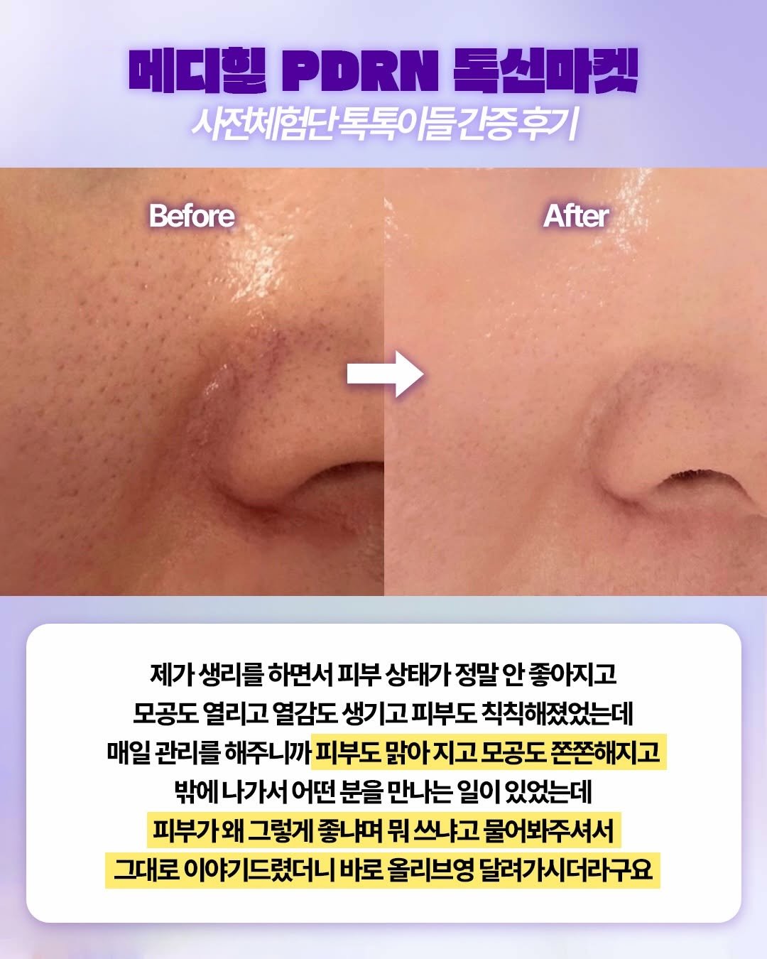 toxin1204 게시물 이미지: 💜메디힐 PDRN 톡신마켓 오늘 마감💜
🔗 구매처 :...