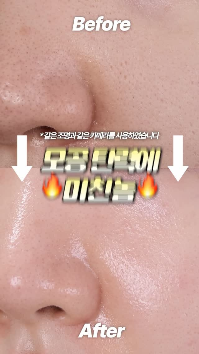 toxin1204 게시물 이미지: 이렇게 모공 탄력이 좋아지는데🔥🔥🔥🔥
이래도 안산다구? 🫪🫪🫪
제발 나중에 안사서 후...