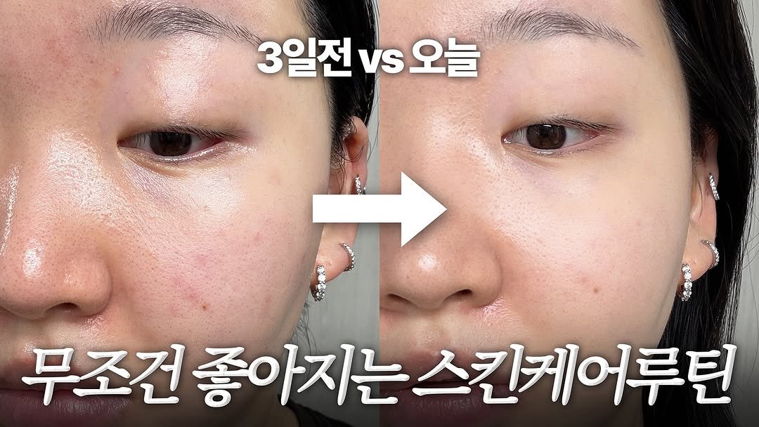 Photo by 톡신 Toxin on November 16, 2025. May be an image of text that says '3일전 3일전vs오늘 vs V.오늘 さの華色だだ 무조건좋아지는 무조건 좋아지는스킨페어루틴 좋아지는 스킨케어루틴 루틴'.