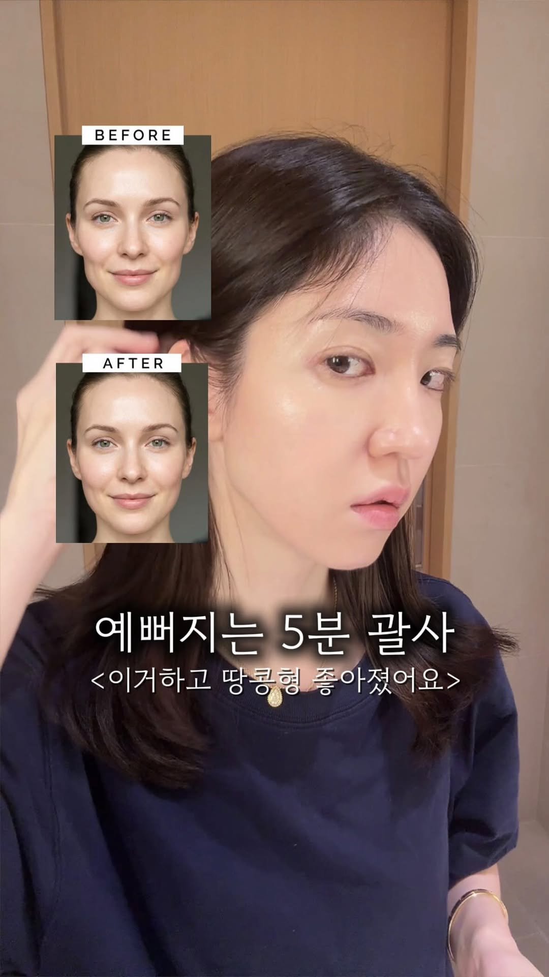 u_yaksa 게시물 이미지: 제가 원래도 얼굴이 좀 긴 편이고, 땅콩형 얼굴형 때문에 쥬베룩 볼륨을 일년에...