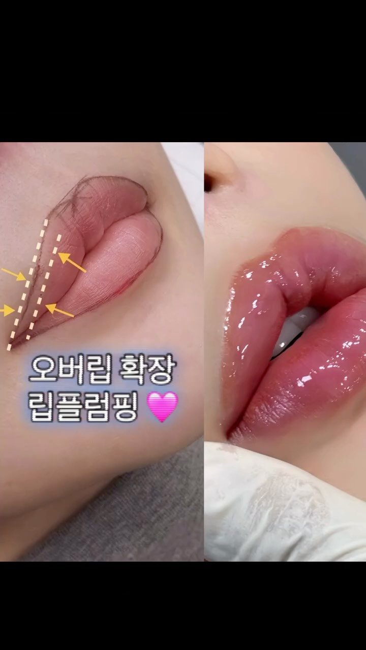 uneed___y 게시물 이미지: .

인기 많았던 궁금해하시던 입술 반영구 확장
리쥬란 + 엑소좀 콜라겐가득...