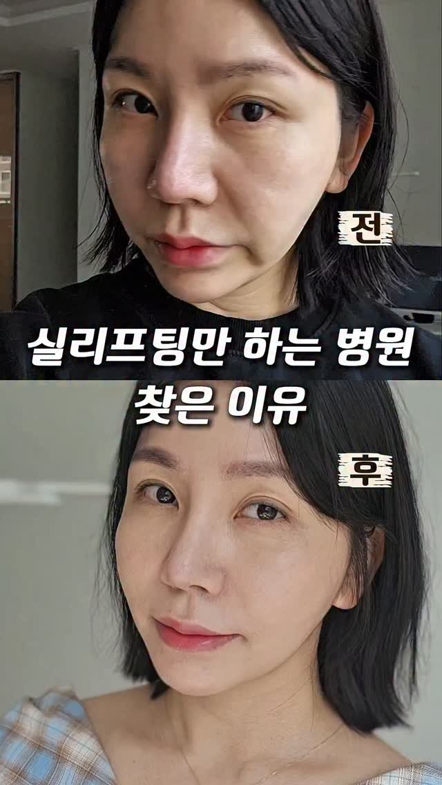 veronica.sh 게시물 이미지: 시술 비용 및 병원 정보▶️ "처짐"
댓글에 달아주세요

나이 들수록 느껴지는 얼굴...