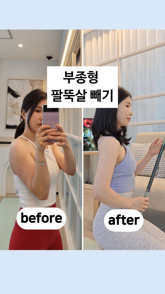 viveza_mins 게시물 이미지: 팔뚝살, 번거로운 오일, 크림없이🙅♀️ 릴렉스틱 하나면 끝!
울퉁불퉁 부종형...