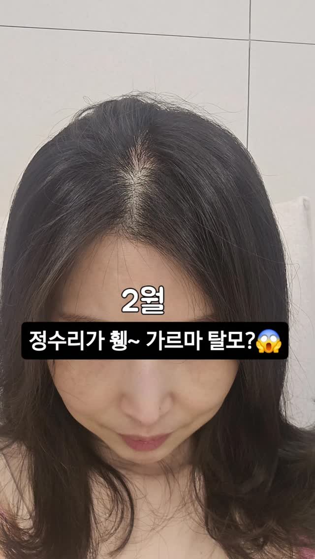 viveza_mins 게시물 이미지: 2월부터 4월까지, 놀라운 머리숱 변화! 드뎌 인생 탈모 샴푸 찾았어요.

지난...