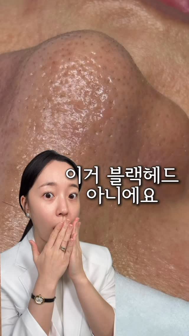 wendy_w_skin 게시물 이미지: 그럼뭔데요?

가시털(속모증) 이라는건데
오래된 피지 각질이 모공에 꽉막혀서
솜털이...