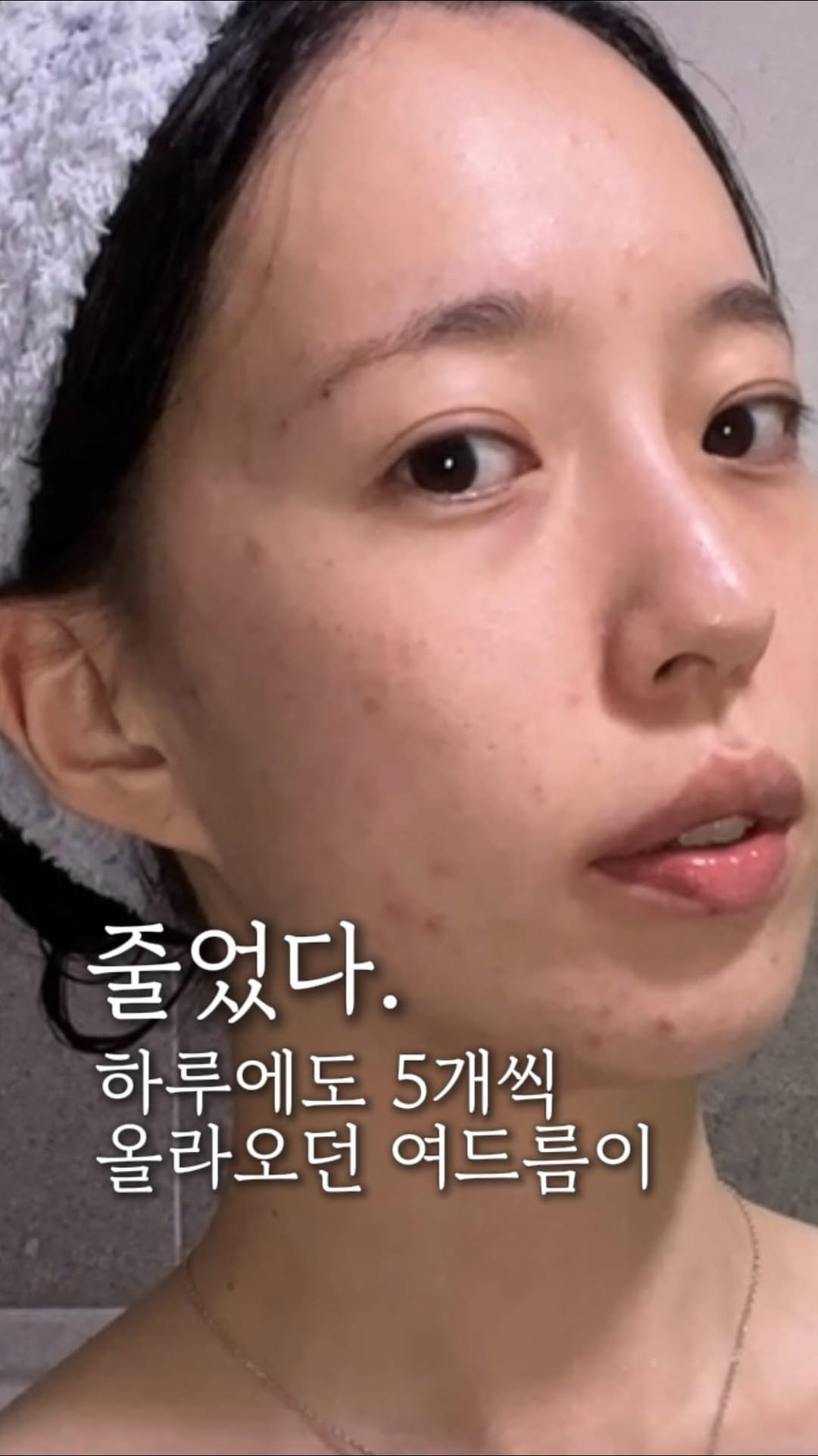 wendy_w_skin 게시물 이미지: 그냥 매일 여드름이 새로 났어요
없어지면 또나고 
없어지기전에 또나고

피부장벽이...