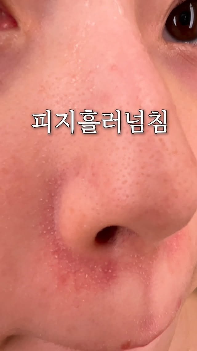 wendy_w_skin 게시물 이미지: 세수해도 남아있는 피지들
모공마다 자리잡은 피지들 
어떻게 관리하세요?

즉각적으로...