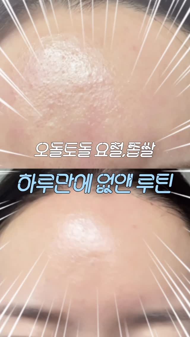 wendy_w_skin 게시물 이미지: 주기적으로 올라오는 이 오톨도톨이들
이거 어떻게 관리하시나요?

사실 이거 뭐라고...