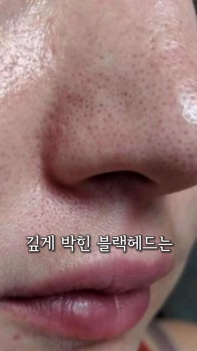 wendy_w_skin 게시물 이미지: 피지선은 건들수록 자극되는거 알고계신가요?
피지는 우리 피부의 당연히...