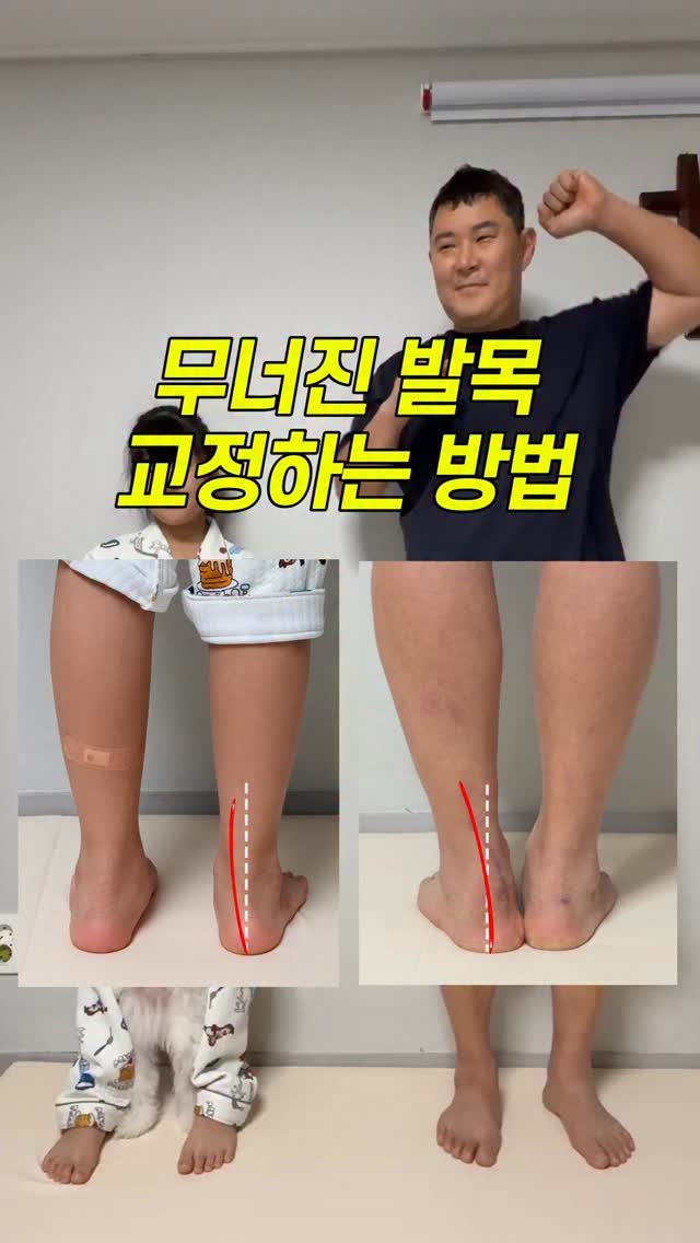 yaenaebubu 게시물 이미지: 평발은 단순히 발 모양의 문제가 아닙니다!

특히 성장기 아이들에게 나타나는...