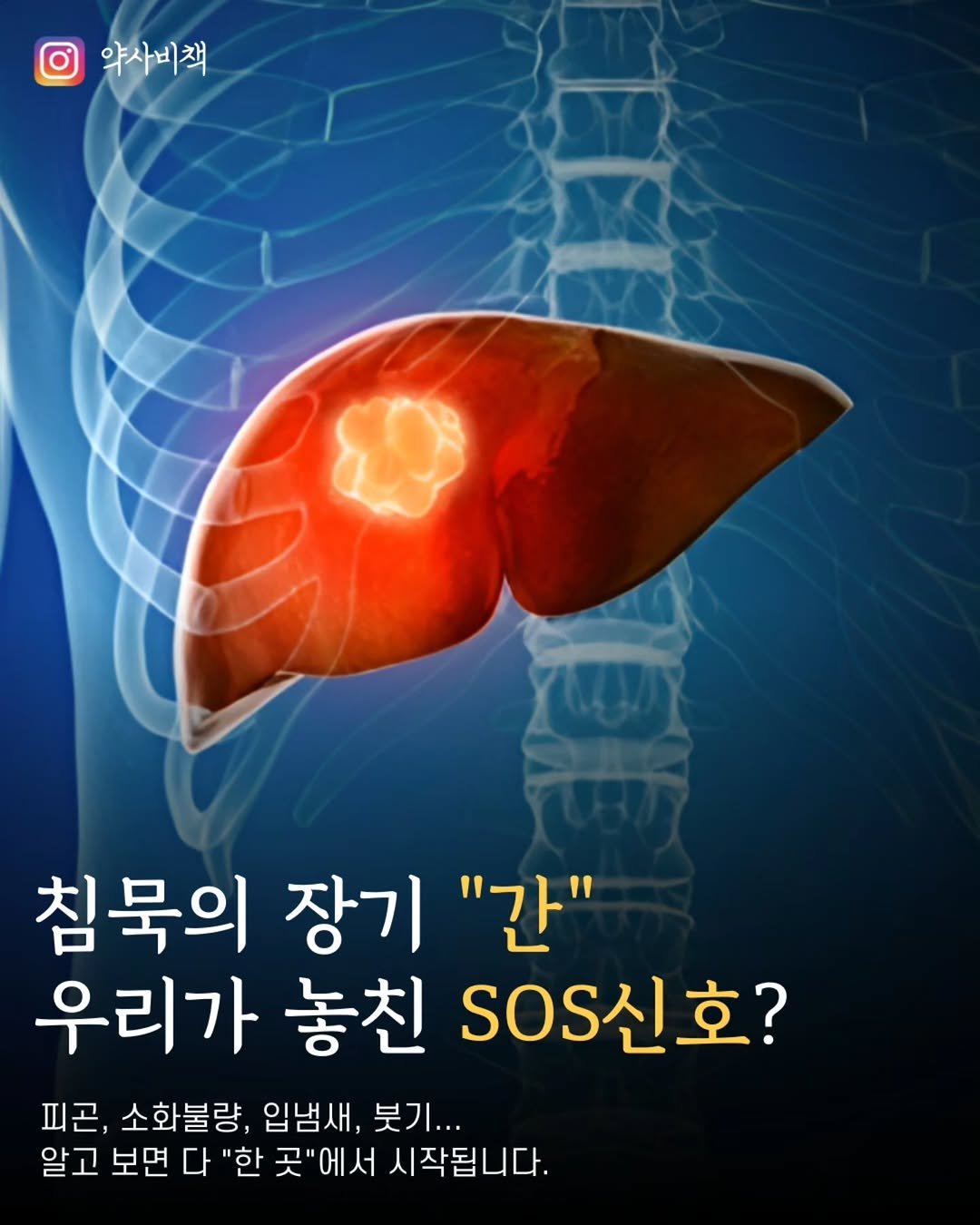 yak_secret 게시물 이미지: 🔻간은 술 때문에만 나빠지는게 아닙니다.🔻

의외로 간이 나빠지는...