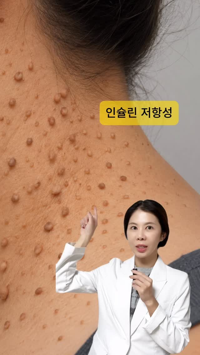 yaksa__bubu 게시물 이미지: 위 증상중 2가지 이상 해당된다면
인슐린 저항성을 당첨입니다

▶️인슐린...