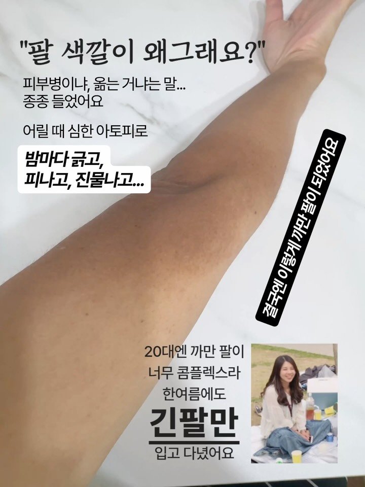 yaksa__bubu 게시물 이미지: “팔색깔이 왜 그래요? 피부병이에요?”
20대때 이런 얘기 너무 많이 들어서...