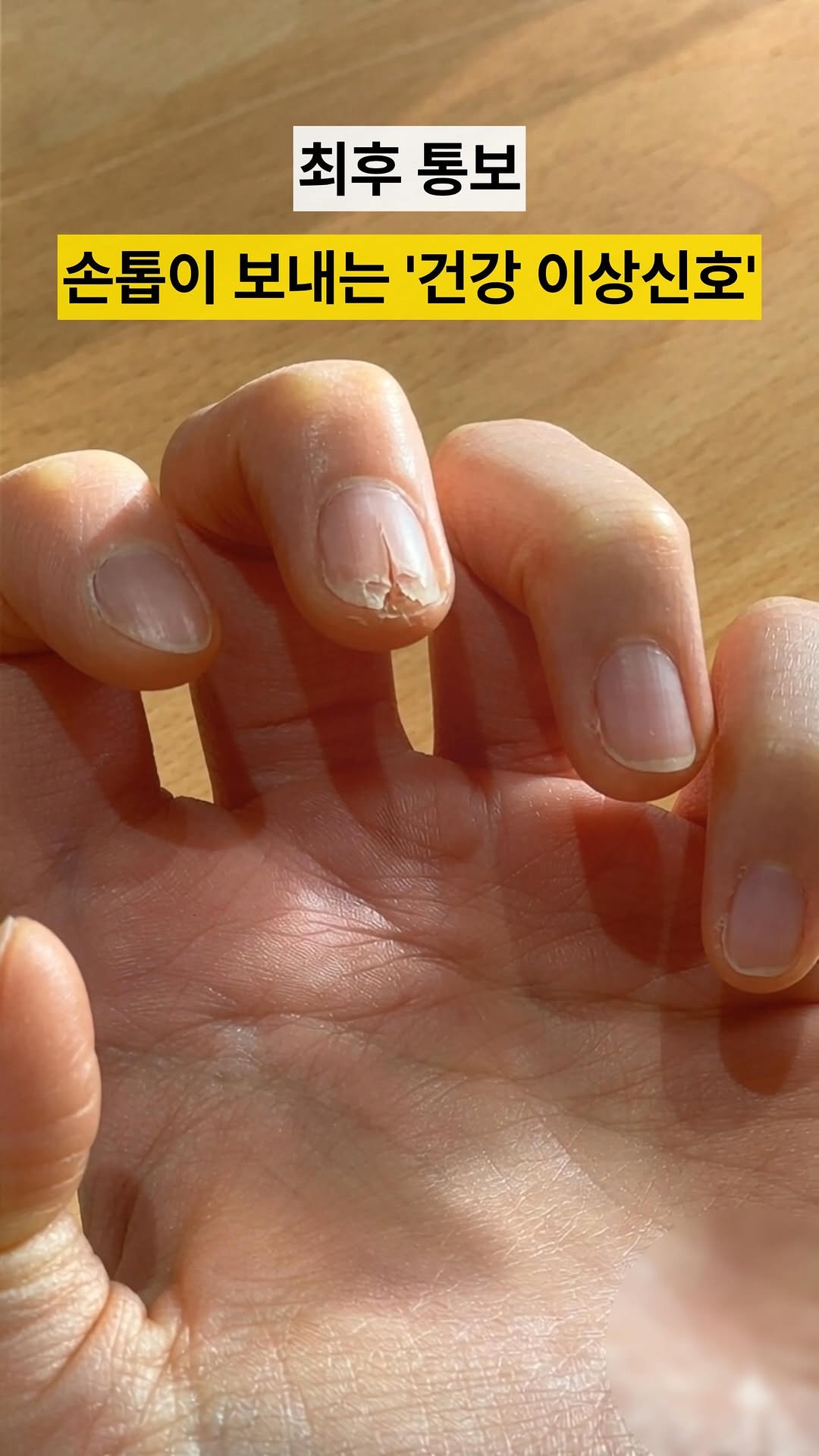 yaksa__bubu 게시물 이미지: 손톱으로 내 건강상태 알아보기🔍

✅손톱이 오목하게 들어감
→ 철분 부족일 가능성...