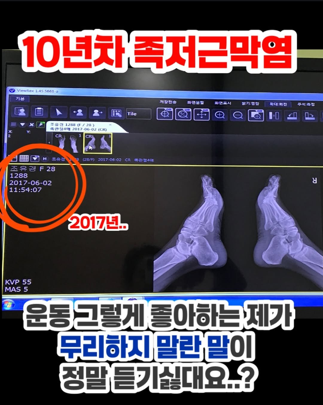 Photo by Youky 조유경 on September 27, 2025. May be an image of ‎1 person, xray, bone and ‎text that says '‎ViewRex 24 1.45 5661- 10년차족저 죽저근막염 제질 제장전송 弟 1288 (F/ 28） 관절 2017 06-02 Tile 파연볼발 화면프시 CR) 밝기 영합 확대 확대:회전 레원 회전 주석측정 10 2017-06-02 죽관절4대 조유경28 1288 1288 2017-06-02 11:54:07 د 2017년.. KVP 55 MAS 5 운동그렇게 좋 아하는 제가 무리하지 하지말란말이 말란 정말 정말듣기싫대요..?‎'‎‎.