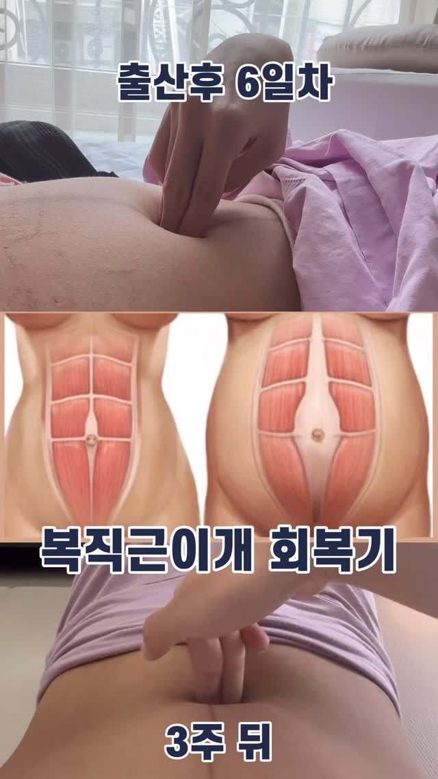 ykayjo 게시물 이미지: 복직근 이개 회복 & 제왕절개 상처 관리
정보가 필요하신 분들은 댓글에 👉🏼...