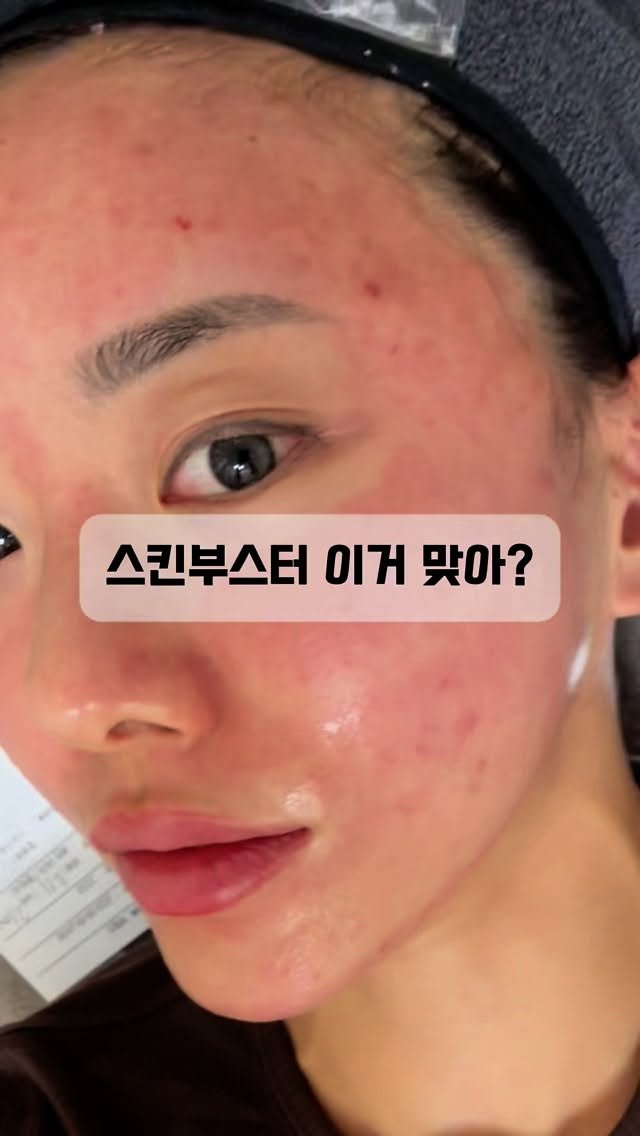 yogini_su_12 게시물 이미지: #콜라스터

피부고민 스킨부스터와 포텐자로 해결하자!!
다양한 피부고민에 맞춰...