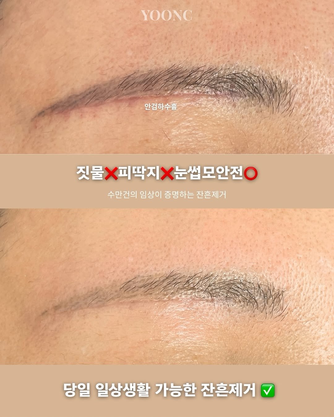 잔흔제거