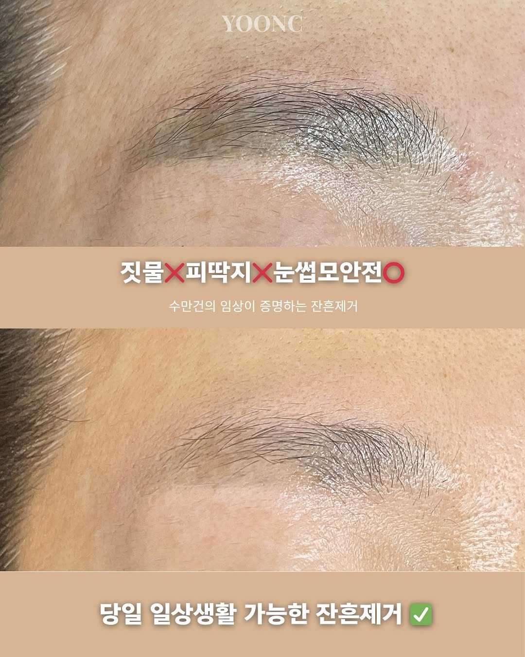 잔흔제거