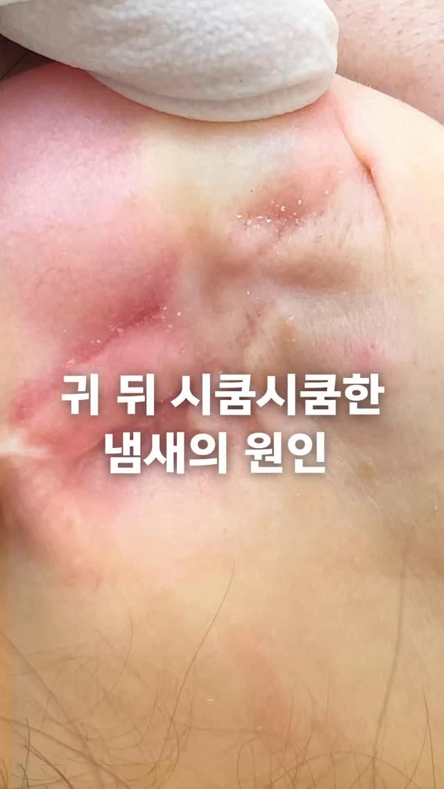 yoonc_atelier 게시물 이미지: ⠀
⠀
귀 뒤에서 나는 시큼시큼한 냄새😳 원인이 뭘까요?
의외로 오래 쌓인 피지와...