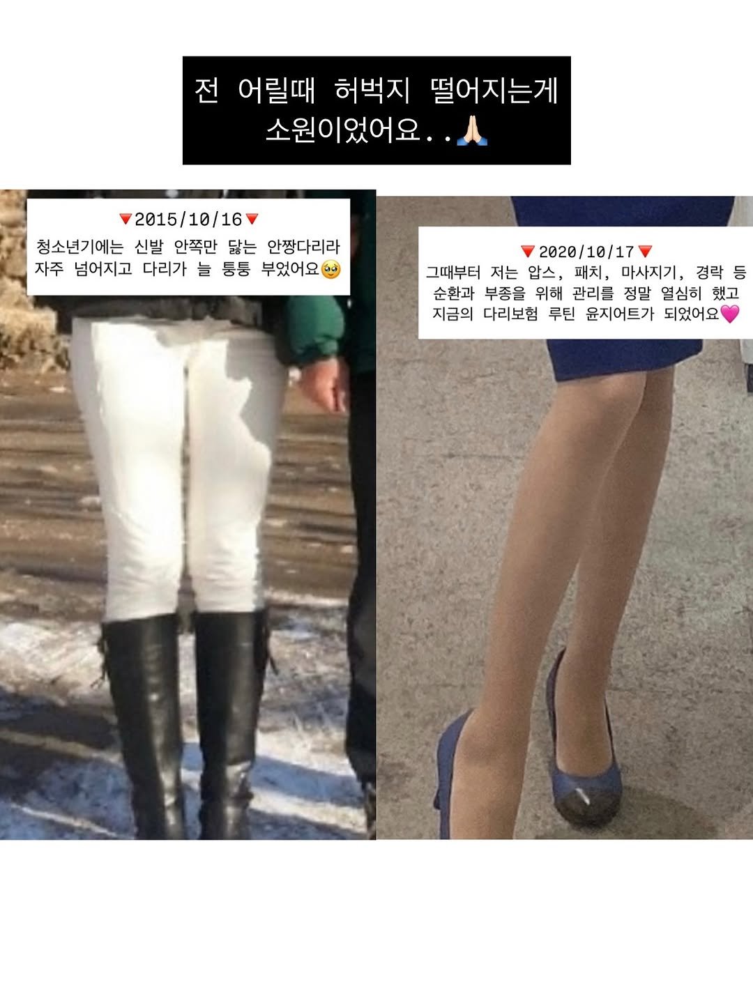 Photo by 윤지어트 | 다이어트• 자기관리 on September 30, 2025. May be an image of 2 people, pants, tights, boots and text that says '전 전 어릴때 허벅지 떨어지는게 소원이었어요.. 2015/10/16 청소년기에는 신발 안쪽만 닮는 안짱다리라 자주 넘어지고 다리가 늘 통통 부었어요 2020/10/17 그때부터 저는 압스, 패치, 마사지기, 경락 등 순환과 부종을 위해 관리를 정말 열심히 했고 지금의 다리보험 루틴 윤지어트가 되었어요'.