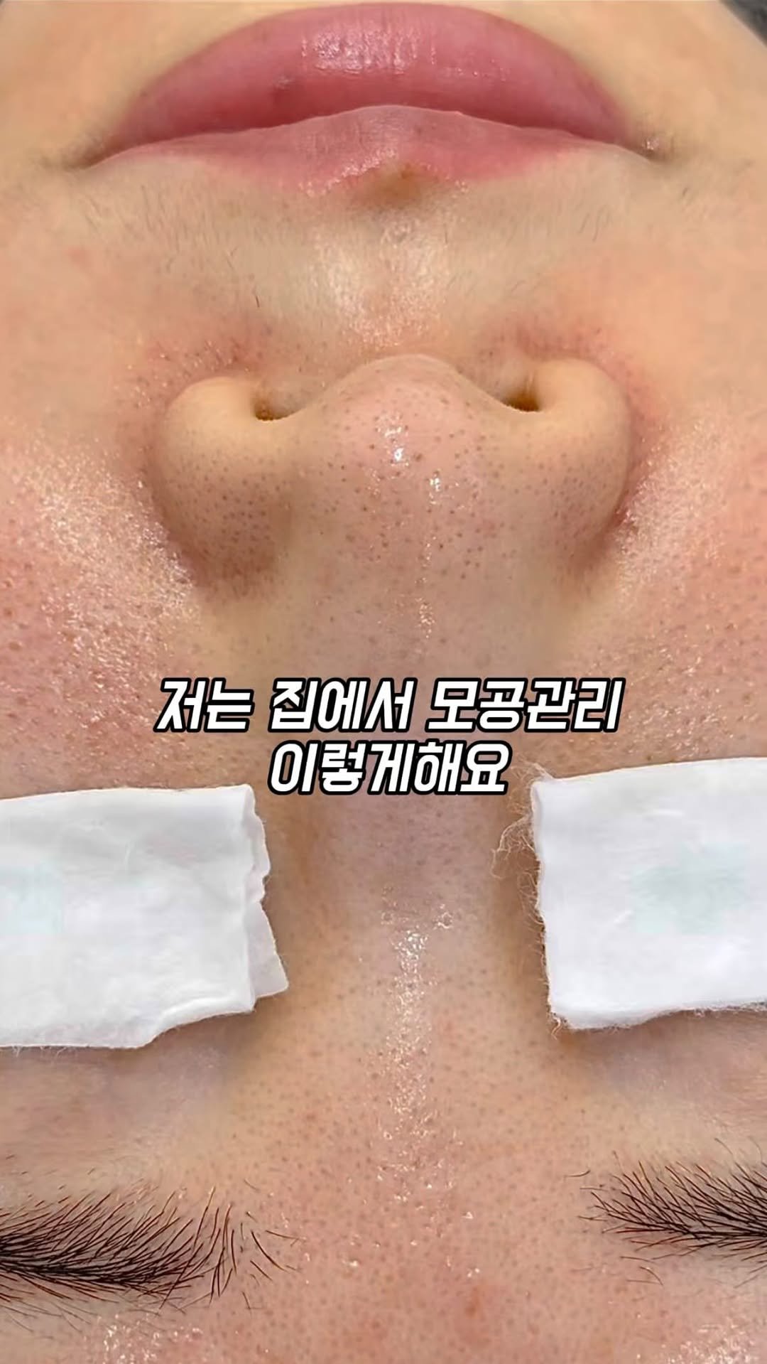 yuli_.yam 게시물 이미지: 저는 집에서 모공관리 이렇게해요

블렉헤드 신경쓰여
짜고 뽑고 긁어내고...