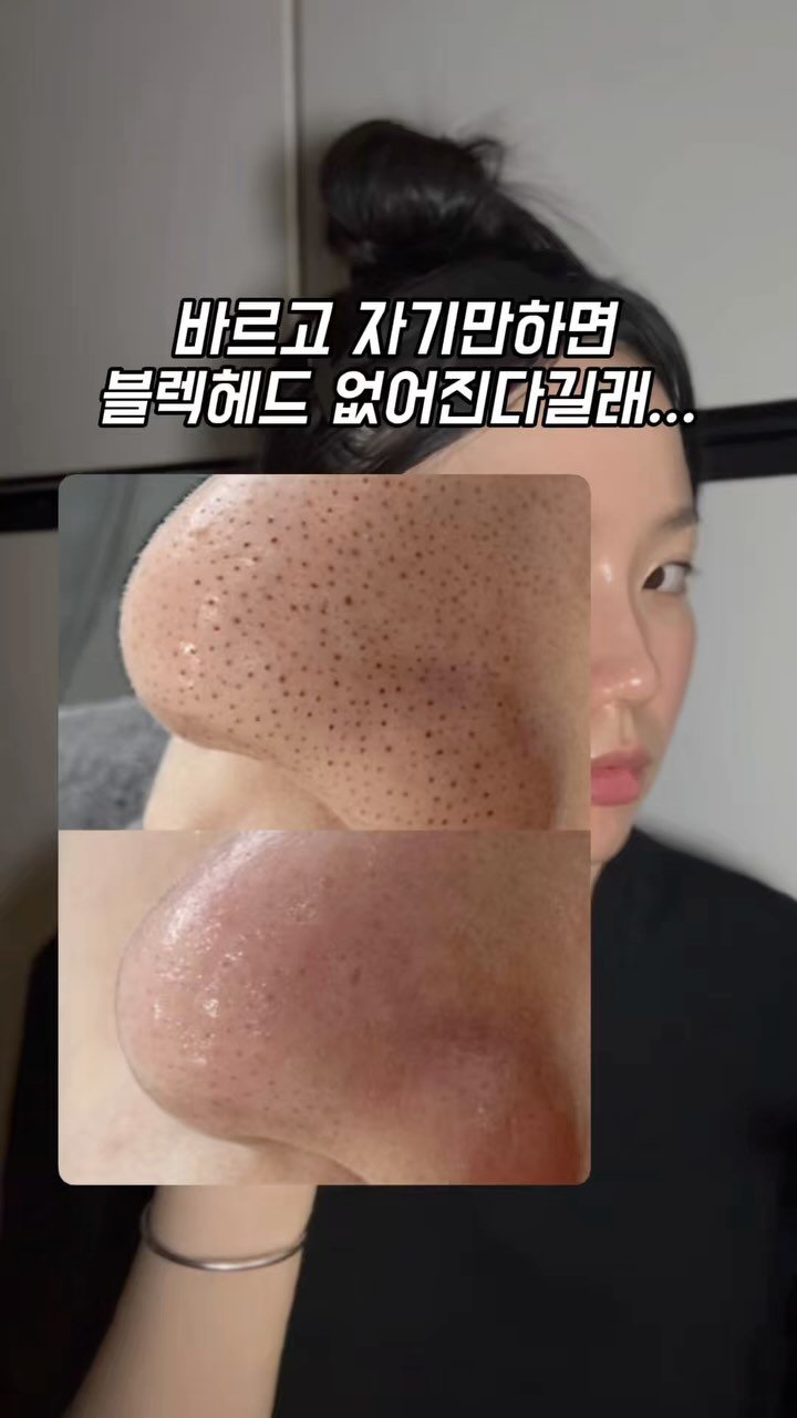 yuli_.yam 게시물 이미지: 바르기만하면 블렉헤드 없어진다길래?
제가 써봤는데 진짜 사라졌어요!!

예민하고...