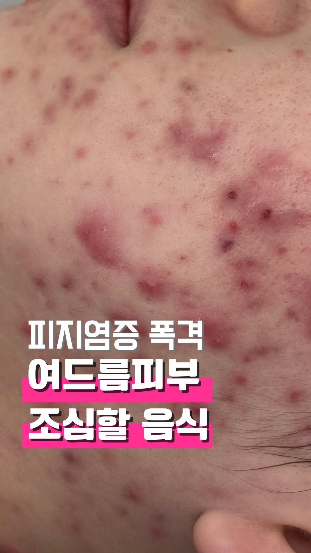 zero_skin 게시물 이미지: 한국인 소울푸드가 여드름 유발 식단 베스트 등극🙊

✔️떡볶이 /마라탕 (피지 염증...