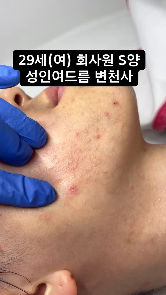 zero_skin 게시물 이미지: 피부과 200만 원 태우고 온 직장인들 👊주목

야근에 스트레스에 밀가루에......