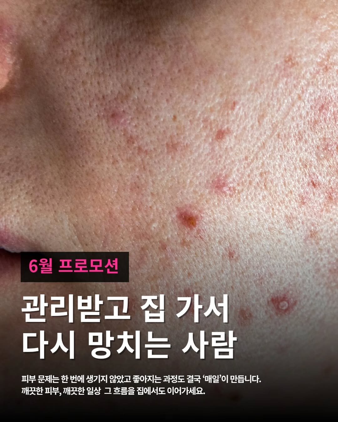 zero_skin 게시물 이미지: 내 피부 상태 모르겠다면 사진 보내주세요.
제로스킨은 그냥 제품 파는 곳 아니라
왜...