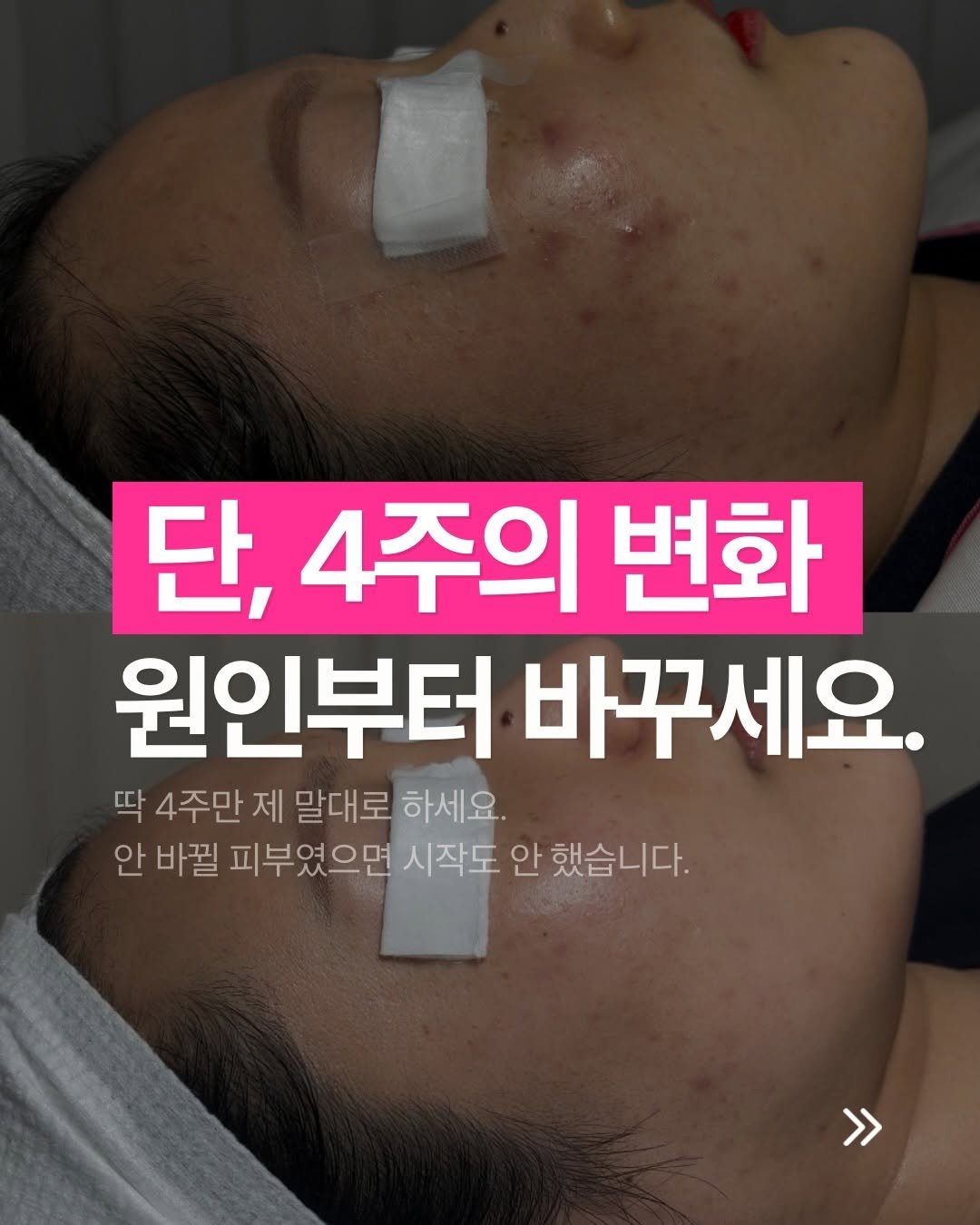 zero_skin 게시물 이미지: 단 2회케어 4주 만에 바뀐 좁쌀과 염증,
그리고 장벽손상없이 매끈해진...