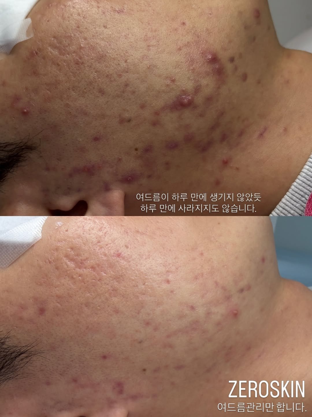 Photo by 대한민국 여드름은 제로스킨/홍대피부관리/아나픈 여드름압출/대표원장 유화영 on February 28, 2026. May be an image of text that says '여드름이 하루 만에 생기지 않았듯 하루 만에 사라지지도 않습니다. ZEROSKIN 여드름관리만 합니다.'.