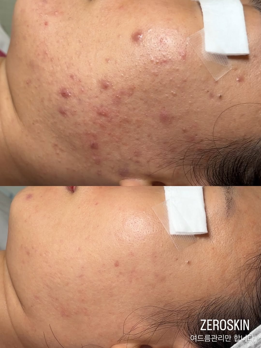 Photo by 대한민국 여드름은 제로스킨/홍대피부관리/아나픈 여드름압출/대표원장 유화영 on February 13, 2026. May be an image of text that says 'ZEROSKIN 여드름관리만 합니다'.