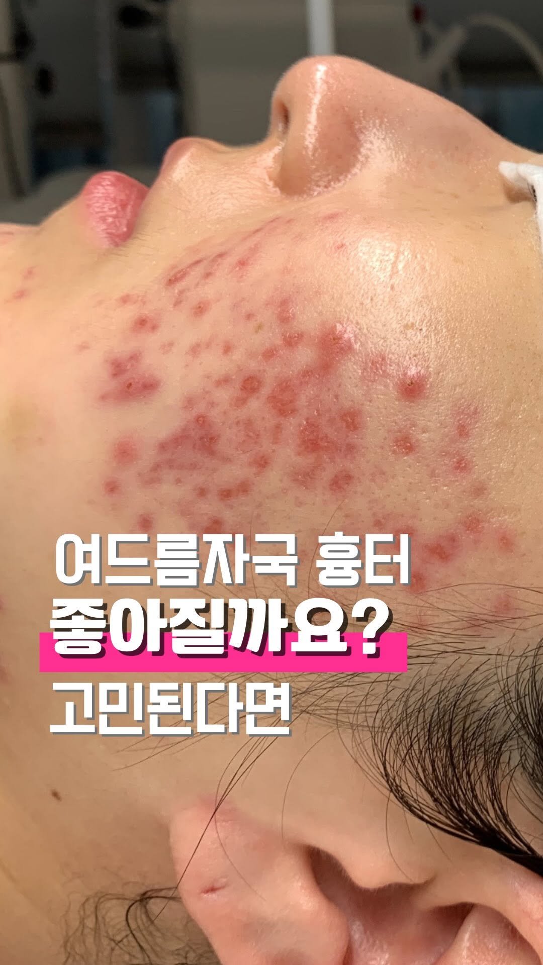 zero_skin 게시물 이미지: 벌래말래.mov 

여드름 관리 변천사 라 부르고
돈 벌어야 하는 이유 라고...